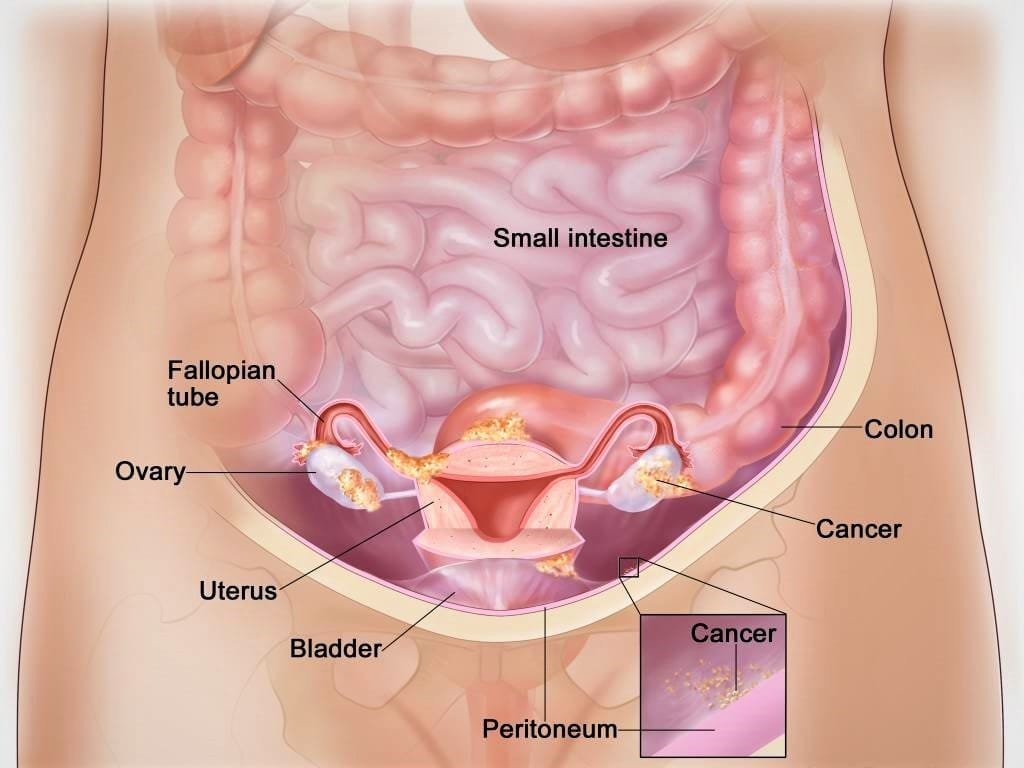 ovarian cancer lump laryngeal papillomatosis injection