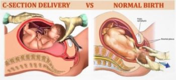 cesarean section cesarean delivery