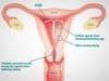 contraceptives IUD mirena