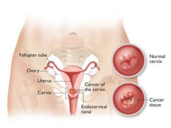 pap smear cervical cancer