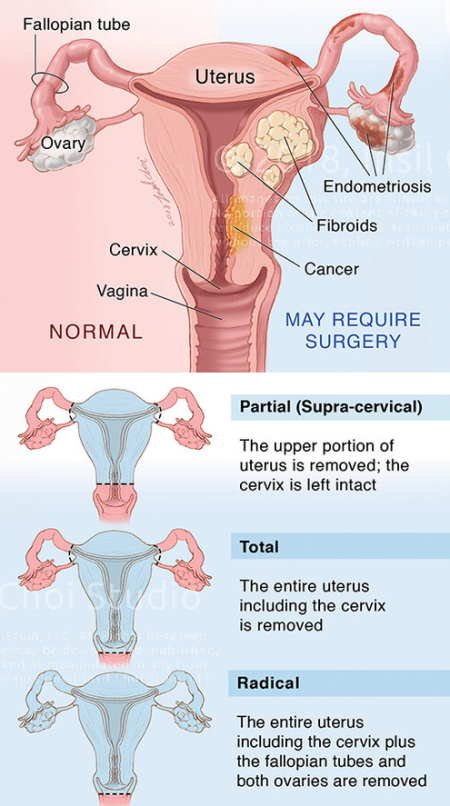 types of hysterectomy