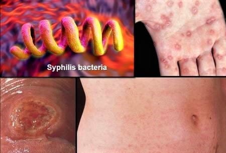 std syphilis