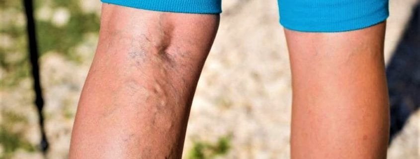 hemorrhoids and varicose veins in pregnancy