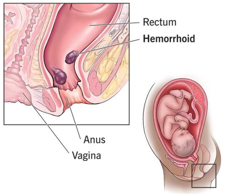 hemorrhoids in pregnancy