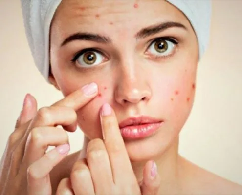 acne causes treatment