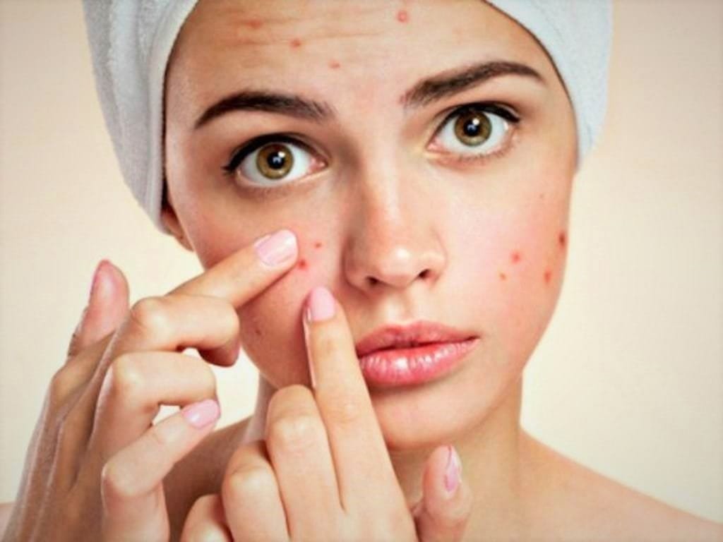 acne causes treatment
