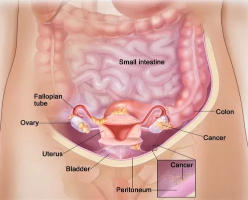 ovarian tumor cysts cancer treatment