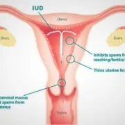 contraceptives IUD mirena