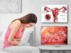 endometriosis symptoms diet treatment self-care