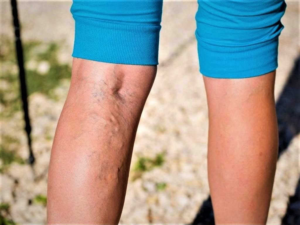 hemorrhoids and varicose veins in pregnancy