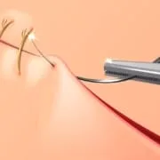 Episiotomy and Vaginal Tears during Childbirth