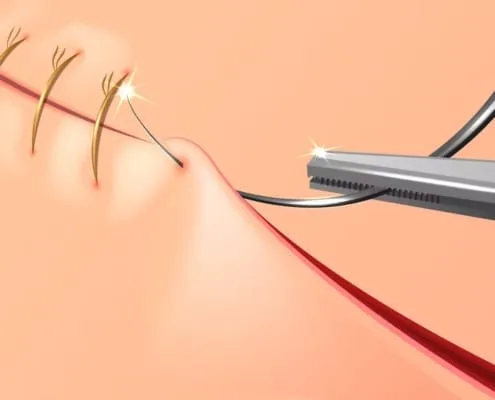 Episiotomy and Vaginal Tears during Childbirth