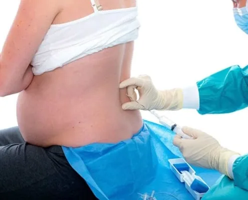 painless delivery epidural injection