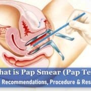 What Is Pap Smear or Pap Test? Age Recommendations, Procedure & Results pap smear test what is a pap smear, abnormal pap smear, pap smear tool