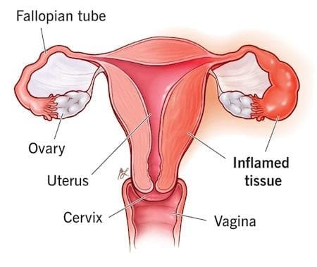 Oophoritis: Symptoms, Causes, and More