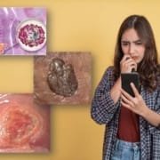 blue waffle disease picture twitter std blue waffle disease picture twitter std