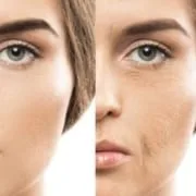 co2 laser before and after picture recovery