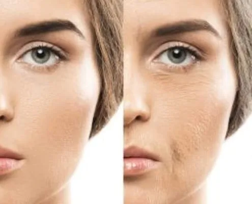 co2 laser before and after picture recovery