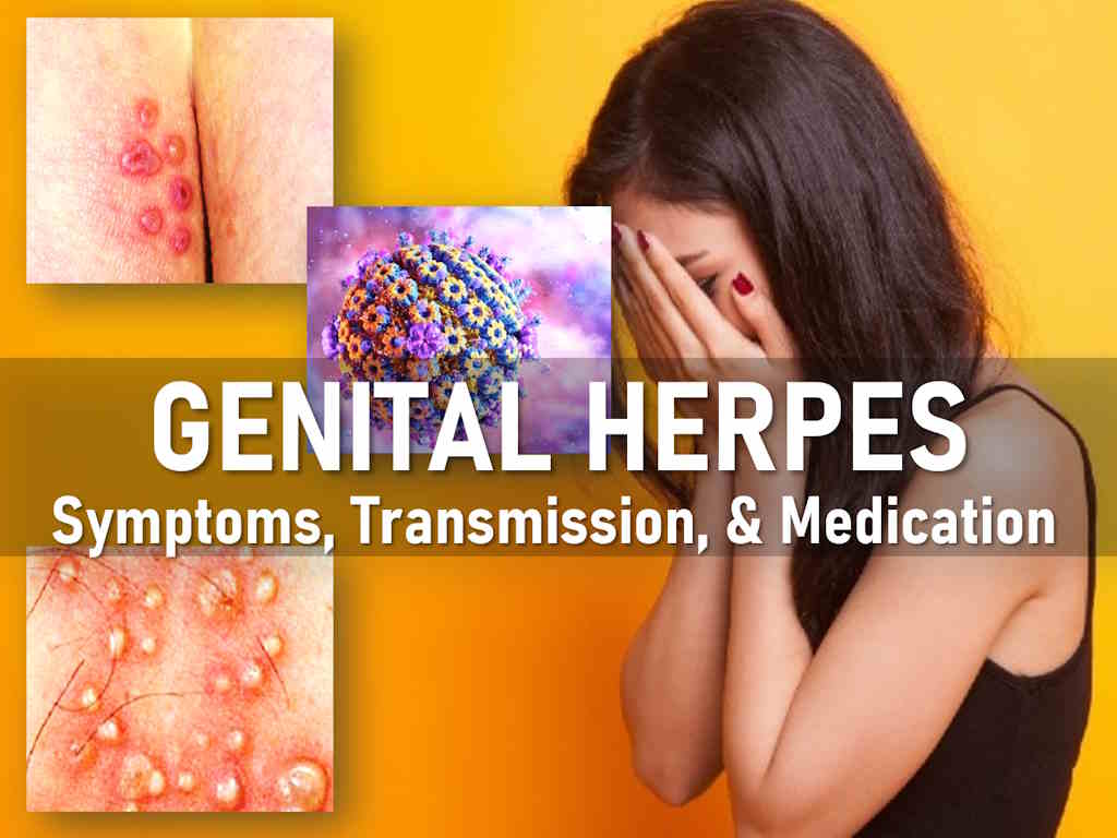 Herpes Female Genital Symptoms