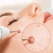 skin tag removal kit, skin tag removal cream