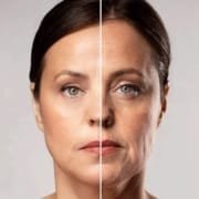 skin tightening before and after pictures best skin tightening cream renuvion