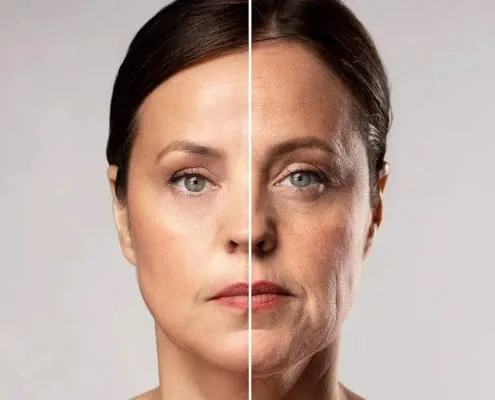 skin tightening before and after pictures best skin tightening cream renuvion