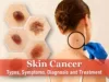 merkel cell skin cancer symptoms, what does skin cancer look like ear scalp itch, skin cancer symptoms, skin cancer look like ear scalp itch, merkel cell skin cancer pictures early stages