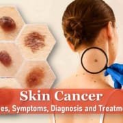 Skin Cancer: Types, Symptoms, Diagnosis and Treatment merkel cell skin cancer symptoms, what does skin cancer look like ear scalp itch, skin cancer symptoms, skin cancer look like ear scalp itch, merkel cell skin cancer pictures early stages