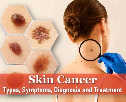 merkel cell skin cancer symptoms, what does skin cancer look like ear scalp itch, skin cancer symptoms, skin cancer look like ear scalp itch, merkel cell skin cancer pictures early stages