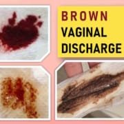 Brown vaginal discharge causes treatment Brown vaginal discharge causes treatment
