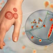 fungal infection symptoms treatment causes fungal infection symptoms treatment causes