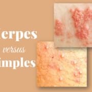 cold sore, genital herpes vs pimple, difference cold sore, genital herpes vs pimple, difference