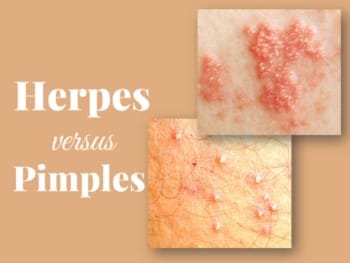 Herpes vs Pimples, How to Spot the Difference - Doctor Zara