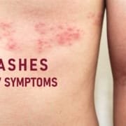 how to identify hiv rash pictures how to identify hiv rash pictures