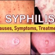 syphilis early stage symptoms treatment rash syphilis symptoms early stage, syphilis rash face legs thigh nasal pictures, syphilis treatment