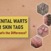 genital warts vs skin tags: pictures hpv men women genital warts vs skin tags: pictures hpv men women