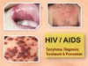 early stage how to identify hiv rash pictures, hiv mouth ulcer, hiv symptoms women