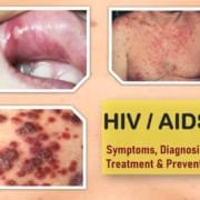 early stage how to identify hiv rash pictures, hiv mouth ulcer, hiv symptoms women early stage how to identify hiv rash pictures, hiv mouth ulcer, hiv symptoms women