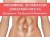 diastasis recti before and after, how to fix diastasis recti years later, pictures of severe diastasis recti