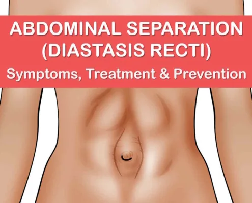 diastasis recti before and after, how to fix diastasis recti years later, pictures of severe diastasis recti