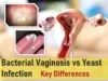 bv vs yeast infection symptoms pictures bv vs yeast infection discharge uti vs bv vs yeast infection trichomoniasis vs bv vs yeast infection