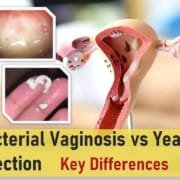 Bacterial Vaginosis vs Yeast Infection vs trichomoniasis bv vs yeast infection symptoms pictures bv vs yeast infection discharge uti vs bv vs yeast infection trichomoniasis vs bv vs yeast infection