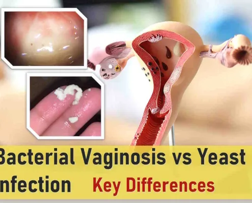 bv vs yeast infection symptoms pictures bv vs yeast infection discharge uti vs bv vs yeast infection trichomoniasis vs bv vs yeast infection