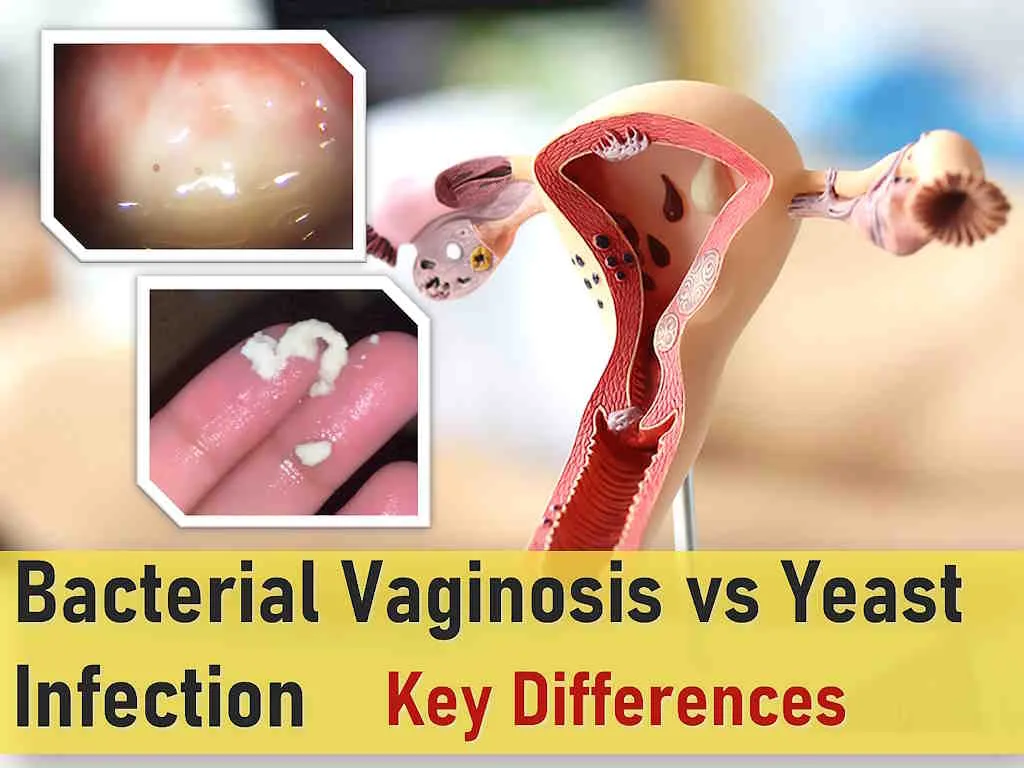 bv vs yeast infection symptoms pictures bv vs yeast infection discharge uti vs bv vs yeast infection trichomoniasis vs bv vs yeast infection