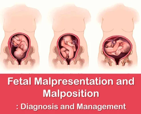 fetal malpresentation and malposition diagnosis and management