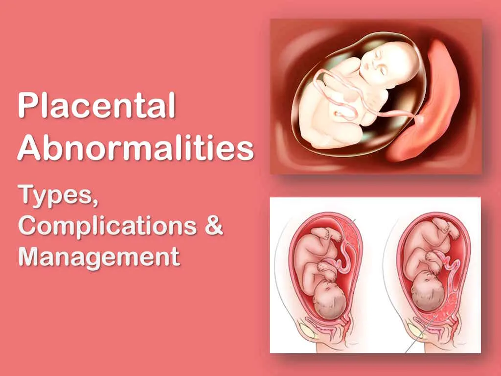 Placenta Previa, Placenta Accreta, Increta, and Percreta, Bilobed and Succenturiate Placenta