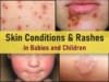 common skin rashes in children pictures, viral allergic itchy rash face arms bums, covid dengue, carpet beetle, dust mites rash
