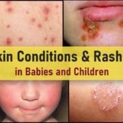 common skin rashes in children pictures, viral allergic itchy rash face arms bums, covid dengue, carpet beetle, dust mites rash
