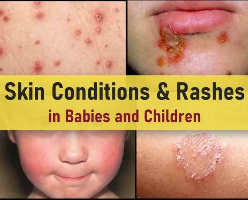 common skin rashes in children pictures, viral allergic itchy rash face arms bums, covid dengue, carpet beetle, dust mites rash