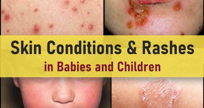 common skin rashes in children pictures, viral allergic itchy rash face arms bums, covid dengue, carpet beetle, dust mites rash